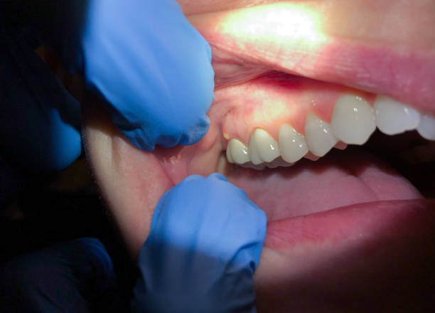 Best Emergency Dental Care for Broken or Chipped Teeth in Los Banos, CA