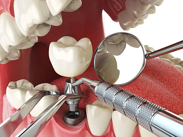Best Emergency Dental Care for Broken or Chipped Teeth in Los Banos, CA